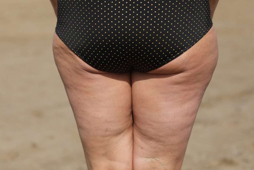 Lipedema vs. Cellulite: How to Spot the Key Differences