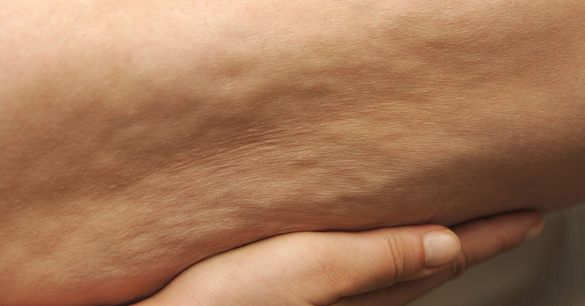 Painful Swelling or Dimples? Lipedema vs. Cellulite Guide